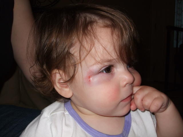 Black eye