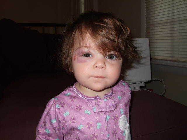 Black eye - the next morning