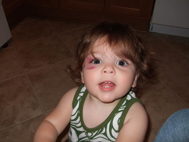 Black eye - true shiner