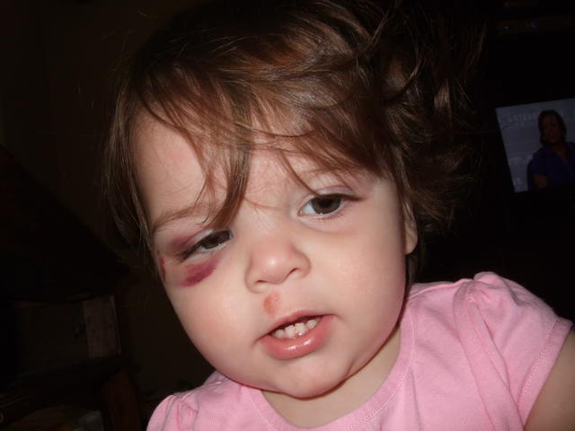 Continued injuries